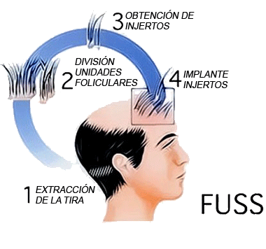 Fases de un trasplante capilar con Técnica FUSS